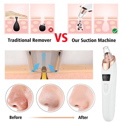 Pore Vacuum & Blackhead Remover